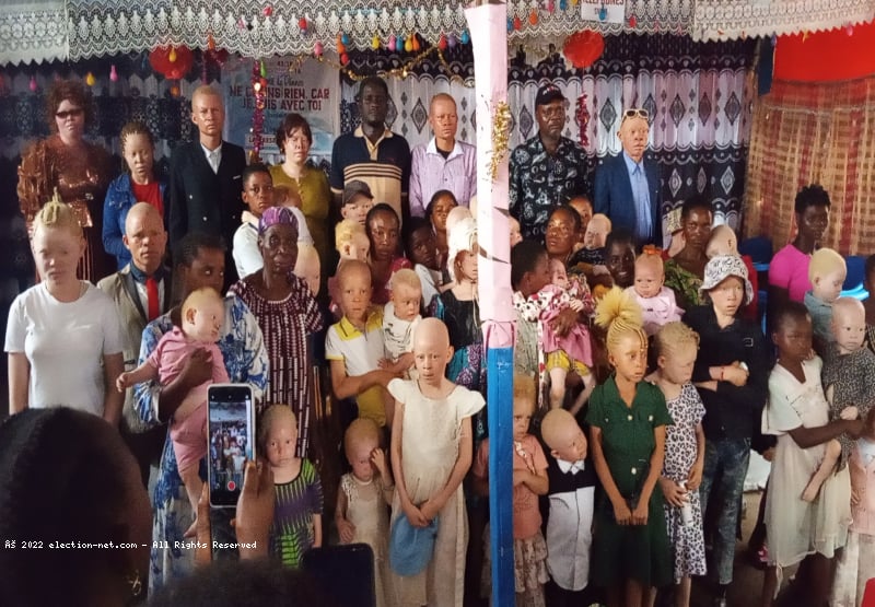 Kasaï-Central : les albinos exigent la fin de leur discrimination