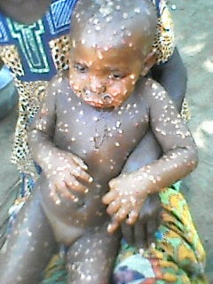 Flash-Sankuru : la maladie de variole de singe tue un enfant à Lodja